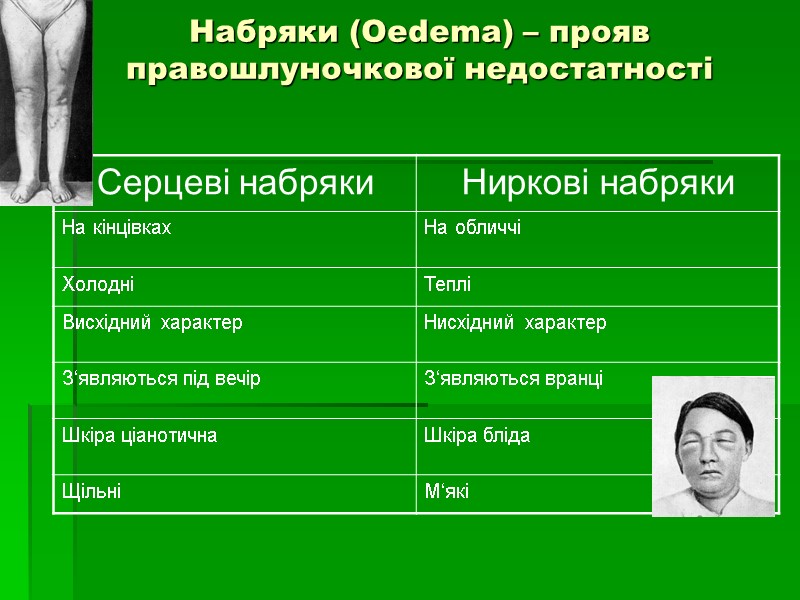 Набряки (Oedema) – прояв  правошлуночкової недостатності